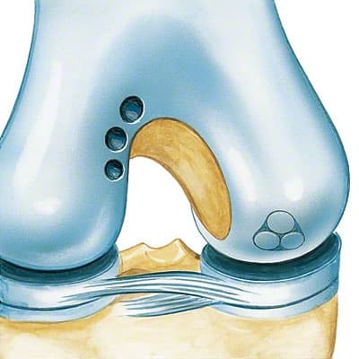 Procart Osteochondrale Transplantation-Produktbild Vergrößerung CW