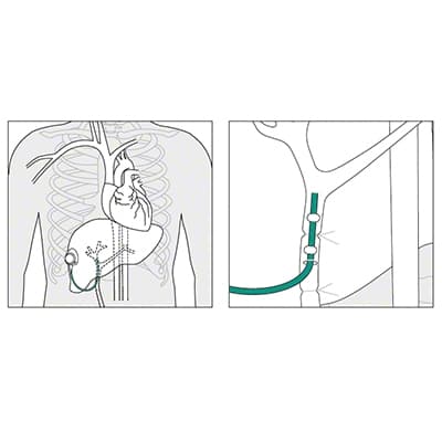 Placement of the Celsite® Arterial-Produktbild Vergrößerung CW